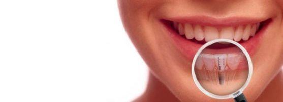 Dej Clinica de Implant Dentar image