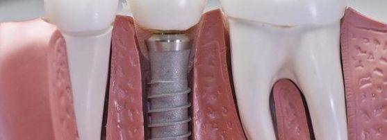 Implant Dentar de Calitate Bucecea image