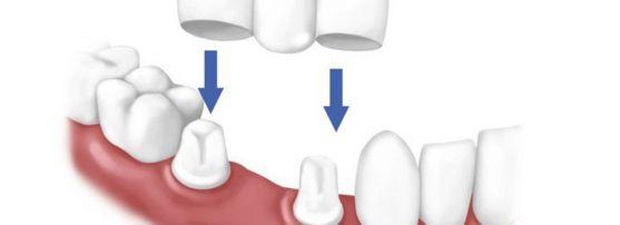 Reparatii Coroana Dentara Baia Sprie image