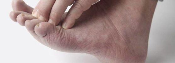 Tratament pentru Ciuperca Piciorului Vicovu de Sus image